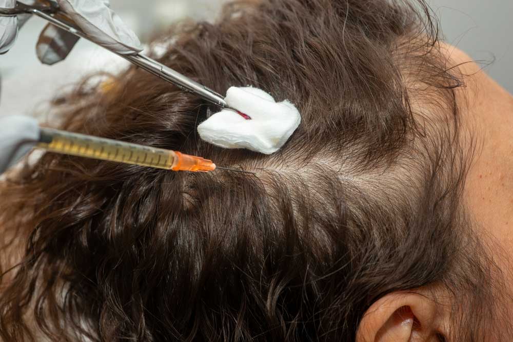 تزریق پی ار پی به سر برای تقویت فولیکول‌های مو