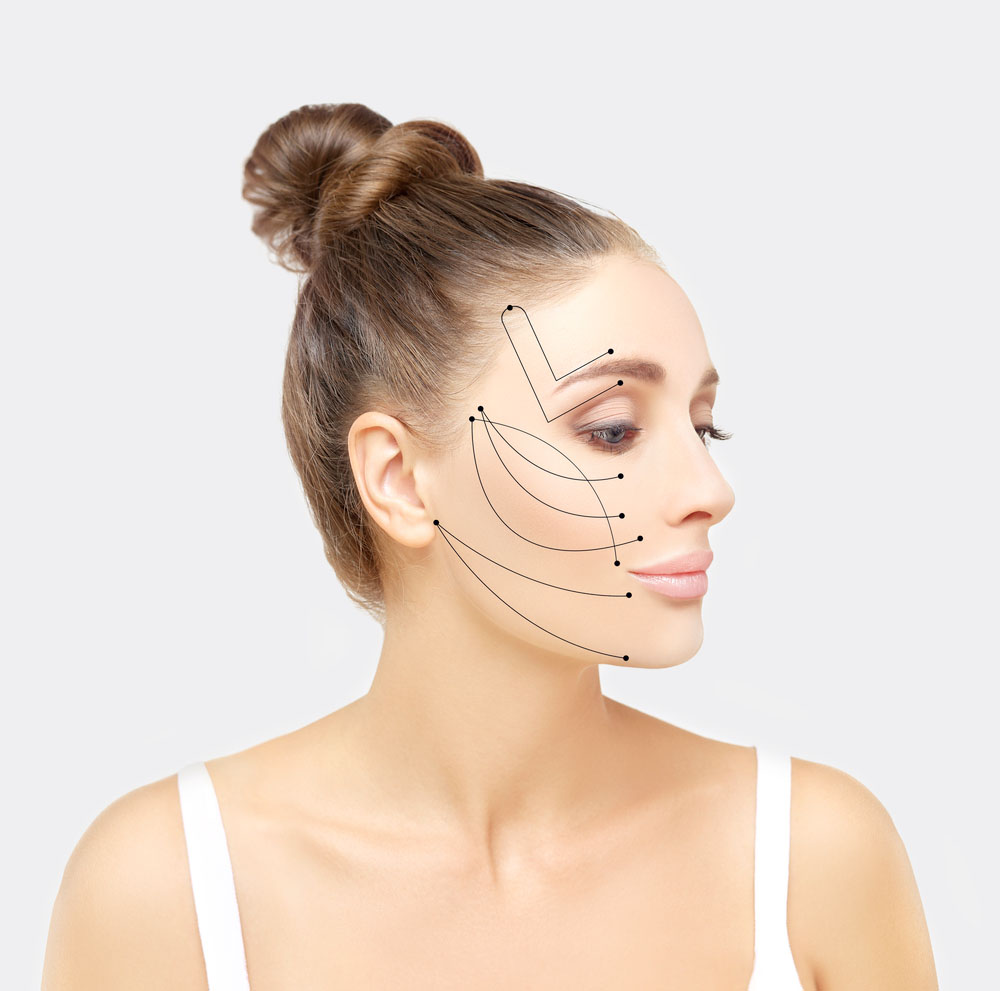 مسیرهای لیفت صورت با نخ