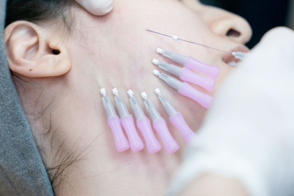 کاندیدای مناسب لیفت صورت با نخ