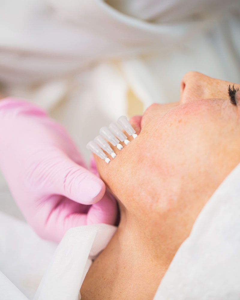 بهترین نوع نخ برای لیفت صورت