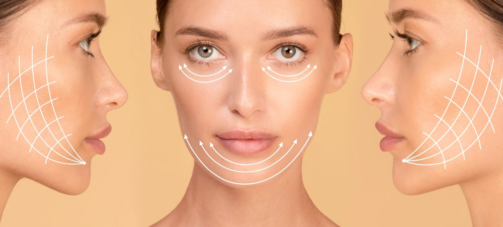 مسیر قرارگیری نخ لیفت صورت