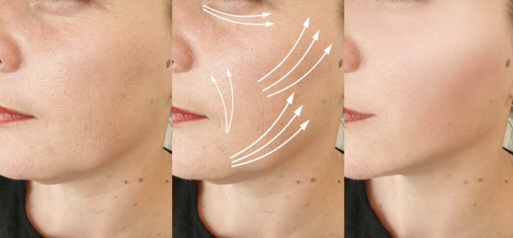 نمونه قبل و بعد لیفت صورت با نخ